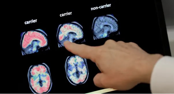 Diagnosing dementia with artificial intelligence