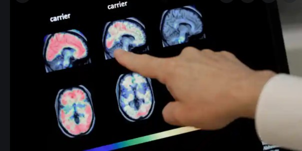 Artificial intelligence diagnose dementia in one day